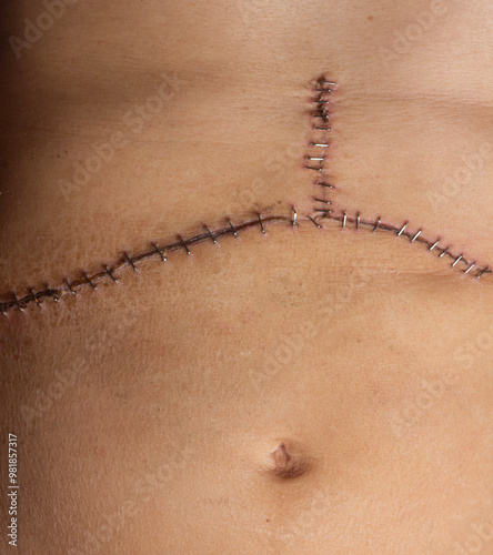 Staples surgical incision healing scar transplant operation closeup