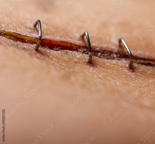 Staples surgical incision healing scar transplant operation closeup