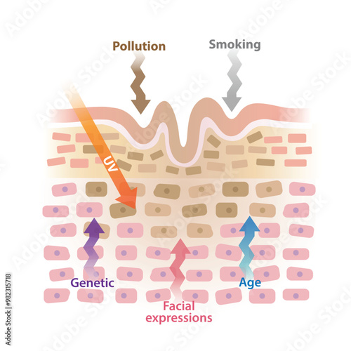 Cause of wrinkles on skin layer vector illustration isolated on white background. Age, ultraviolet radiation, smoking, pollution, facial expressions, genetic causes lines and creases to form on skin.