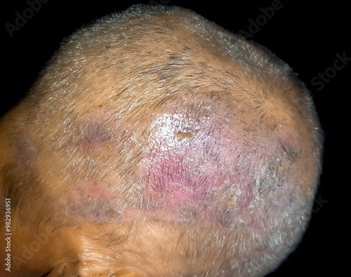 Tinea Capitis or Fungal Infection on the scalp