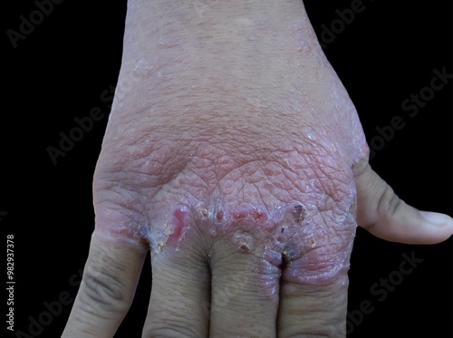 Psoriasis on the hand characterized by red, scaly patches and cracked skin. photo