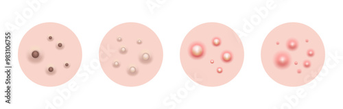 Acne skin pimple, vector illustration
