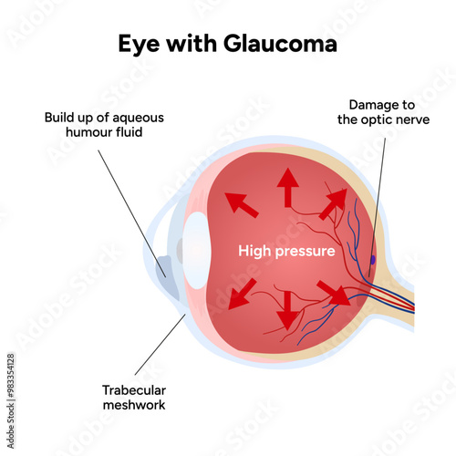 Eye with glaucoma disease, medical infographic with human eye optic anatomy