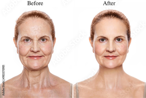 Rehabilitation of the skin and muscles of the face and neck in adulthood. Before and after revitonics, lifting and facebuilding photo