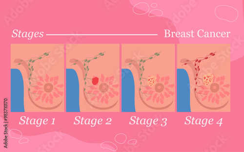 stages of breast cancer infographic awareness flat illustration