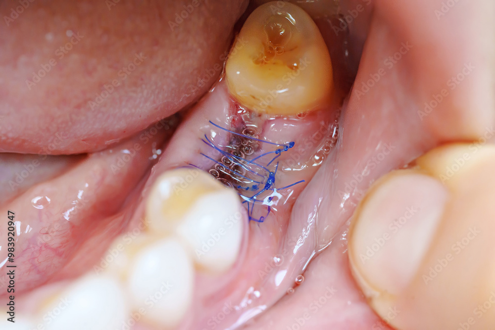 Obraz premium close-up. a sutured socket in the oral cavity after tooth extraction. the work of a dentist surgeon.