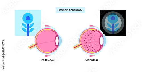 Retinitis pigmentosa poster photo