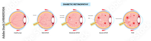 Diabetes related retinopathy