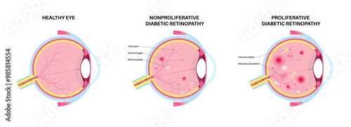 Diabetes related retinopathy