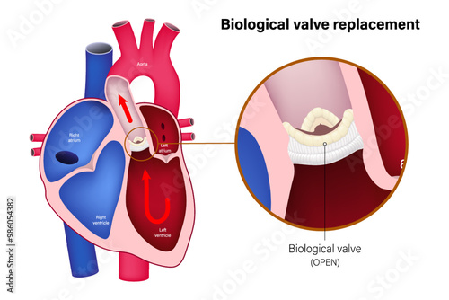 Aortic valve replacement with biological valve. Close up of open biological valve. Heart anatomy vector. 