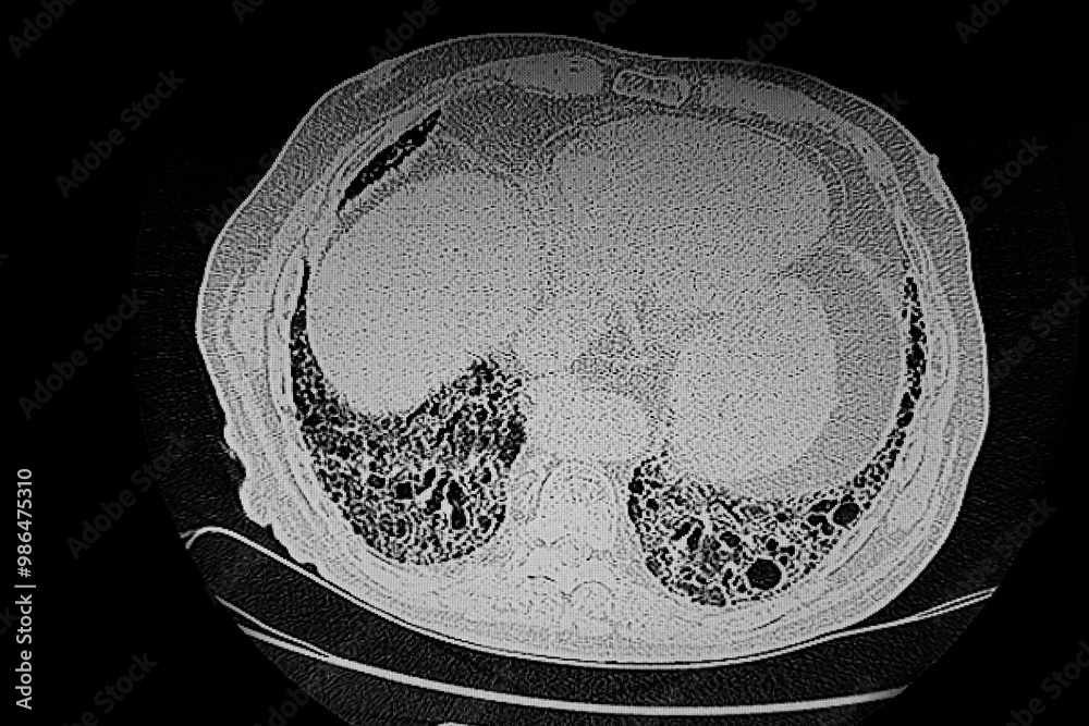 Medical themes: CT SCAN of idiopathic pulmonary fibrosis