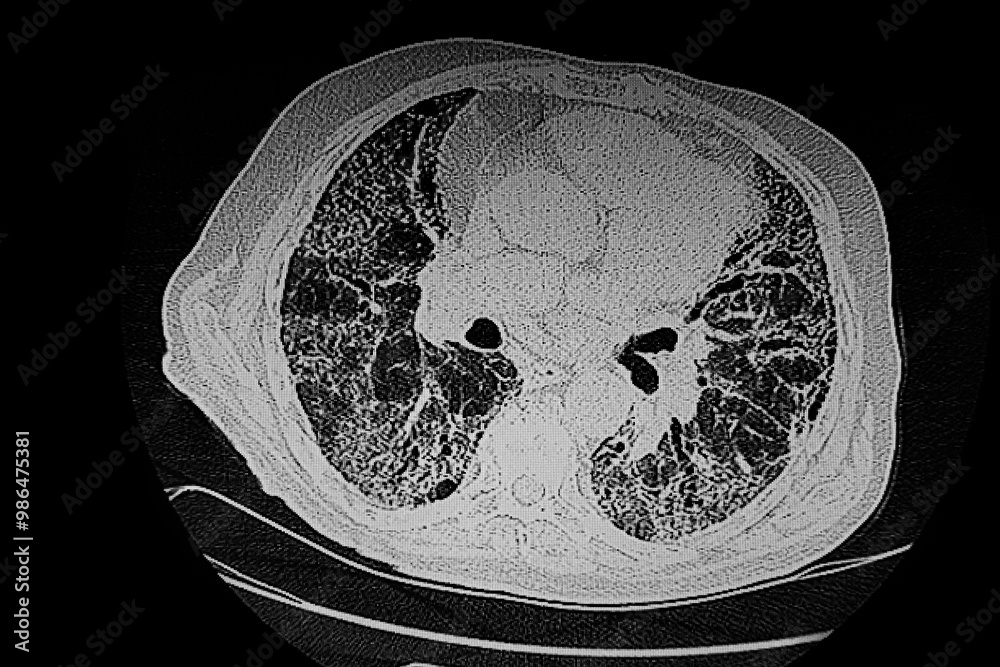 Medical themes: CT SCAN of idiopathic pulmonary fibrosis
