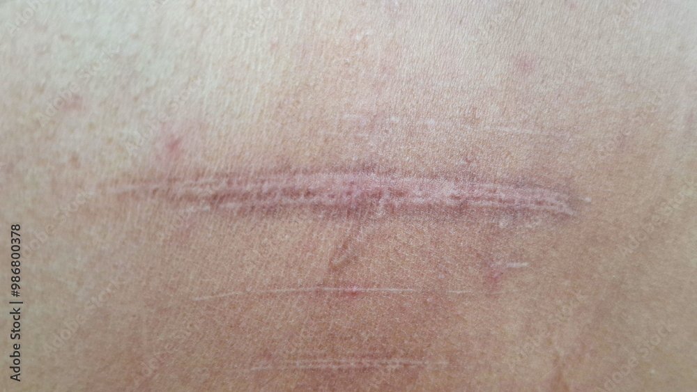 Fototapeta premium Accidents leave scars on the skin.