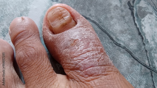 the skin of the big toe is cracked and watery. eczema disease photo