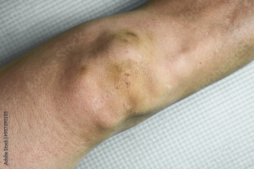 Bruises on the skin of the knee, a close-up injury, for suffering from a wound, an accident, the concept of medicine. photo