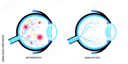 Diabetes related retinopathy