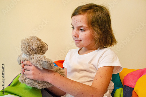 Natural vaccination. Contagious disease. Sick child with chickenpox. Varicella virus or Chickenpox bubble rash on child body and face. High quality photo.  photo