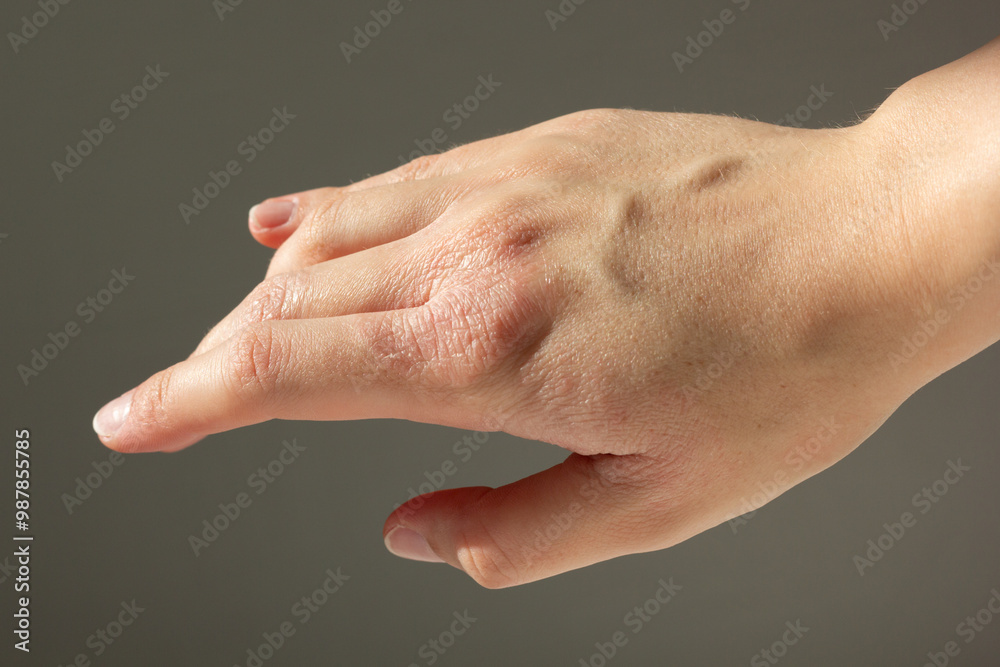 Close-up of a woman’s hands with eczema flare-up.