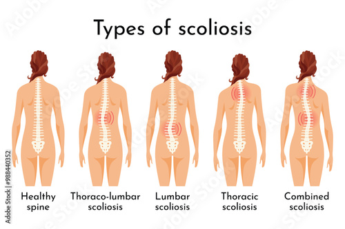 This article covers the different types of scoliosis affecting individuals of all ages