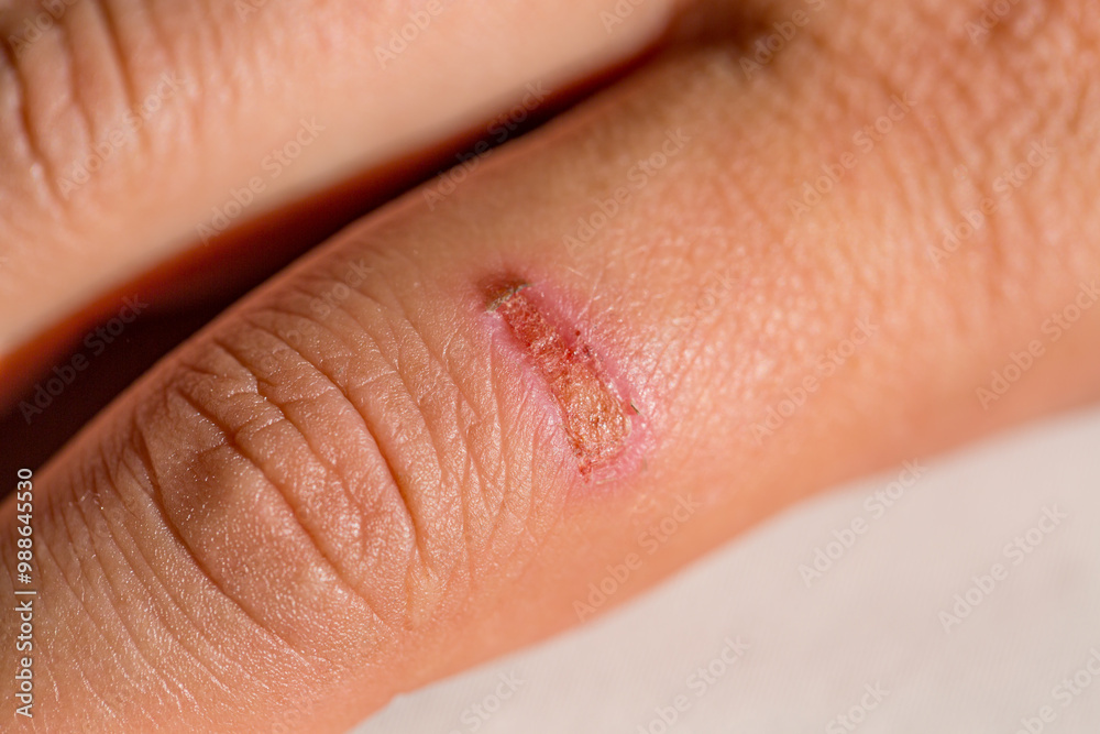 Fototapeta premium Close up image of severe burn on a womans finger from cooking.