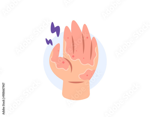 desquamation. illustration of a hand with peeling and dry skin. peeling, irritated, itchy and sore skin. allergy. health problems and skin diseases. flat style design. elements