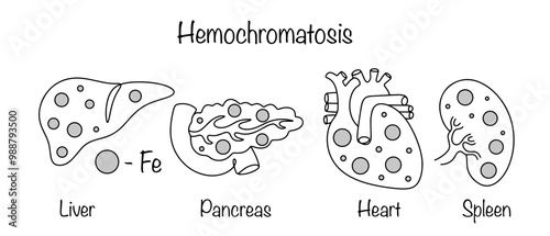 Hemochromatosis
