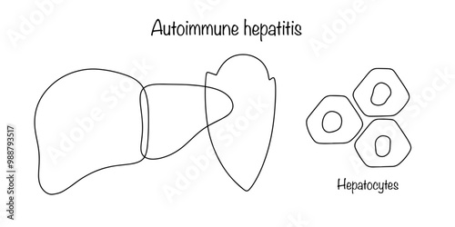 Autoimmune hepatitis