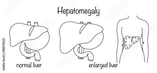 Hepatomegaly photo