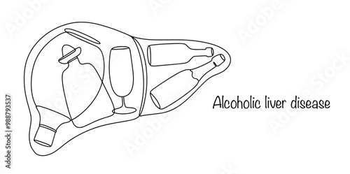 Liver and alcohol