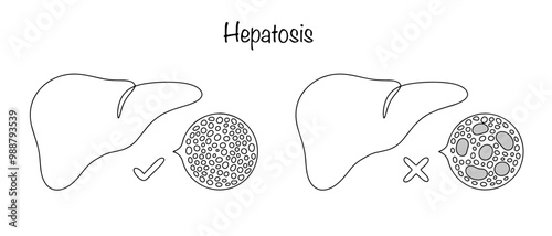 Hepatosis