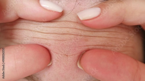 Female hands touching and squeezing her forehead wrinkles lines close up. Aging problems concept