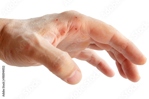 cat bite wound on hand, isolated