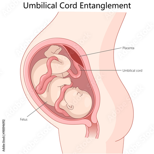 umbilical cord entanglement around a fetus, potential pregnancy complications and anatomical details diagram hand drawn schematic vector illustration. Medical science educational illustration