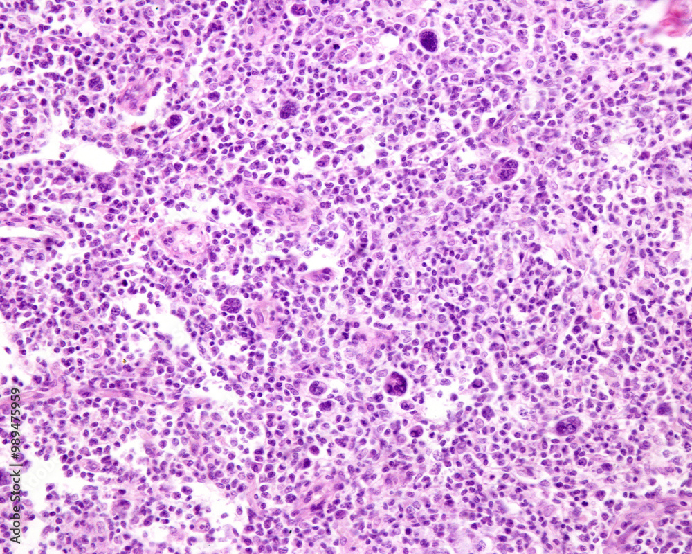 Lymph node. Hodgkin lymphomah