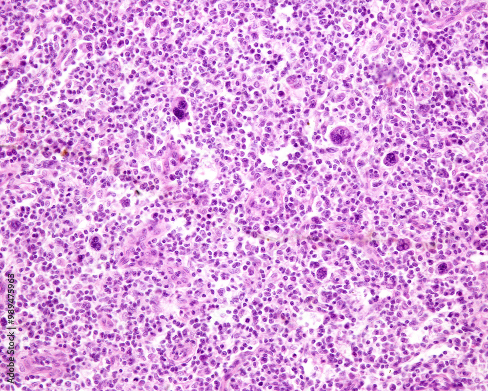 Lymph node. Hodgkin lymphoma Lymph node. Hodgkin lymphoma