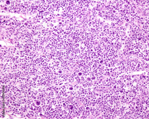 Lymph node. Hodgkin lymphoma photo