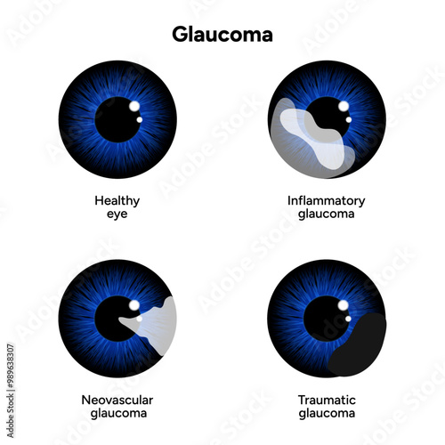 Healthy eye and eye with glaucoma. Ophthalmology. Inflammatory glaucoma. Neovascular glaucoma. Traumatic glaucoma
