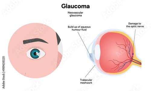 Healthy eye and eye with glaucoma. Ophthalmology. Neovascular glaucoma