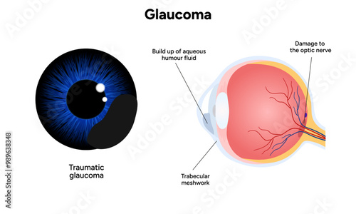 Healthy eye and eye with glaucoma. Ophthalmology eye examination. Traumatic glaucoma