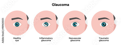 Healthy eye and eye with glaucoma. Ophthalmology. Inflammatory glaucoma. Neovascular glaucoma. Traumatic glaucoma