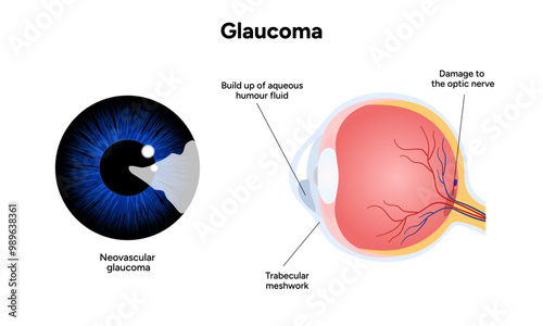 Healthy eye and eye with glaucoma. Ophthalmology. Neovascular glaucoma