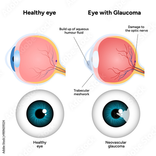 Healthy eye and eye with glaucoma. Ophthalmology eye anatomy. Neovascular glaucoma