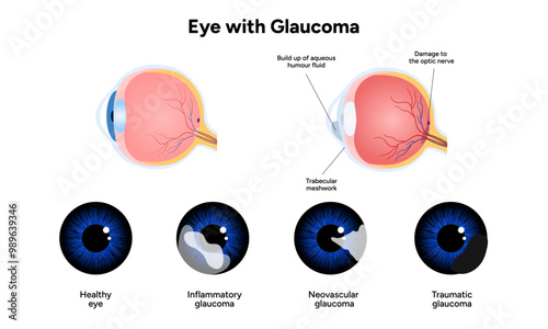 Healthy eye and eye with glaucoma. Ophthalmology eye anatomy. Inflammatory glaucoma. Neovascular glaucoma. Traumatic glaucoma
