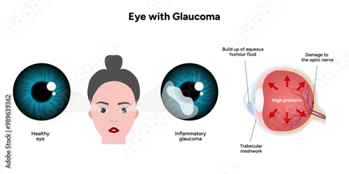 Healthy eye and eye with glaucoma. Ophthalmology eye anatomy. Inflammatory glaucoma