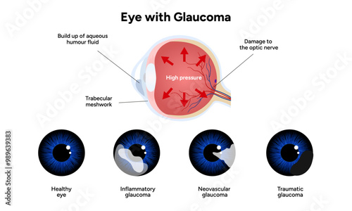 Healthy eye and eye with glaucoma. Ophthalmology eye anatomy. Inflammatory glaucoma. Neovascular glaucoma. Traumatic glaucoma