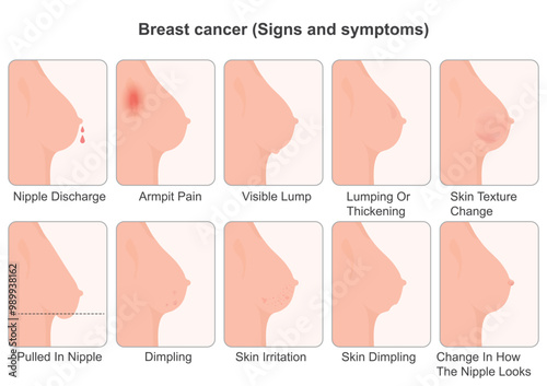 Warning signs and symptoms of Breast cancer.