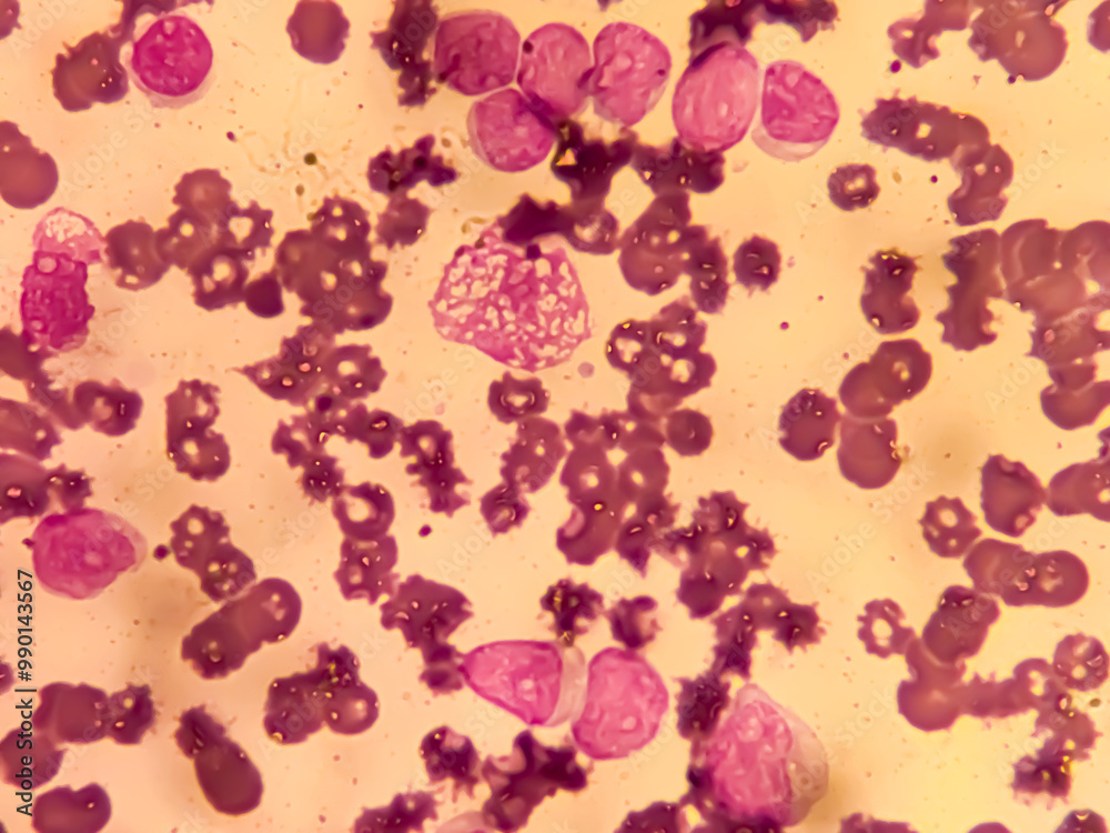 Chronic myeloid leukemia cells or CML, analyze by microscope. Blood ...