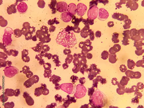 Chronic myeloid leukemia cells or CML, analyze by microscope. Blood cancer cells image. photo