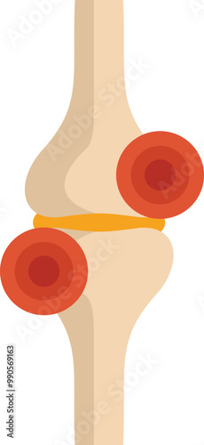 This medical illustration depicts the concept of knee pain, often associated with conditions like arthritis