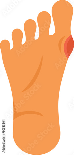 Illustration depicting the foot condition hallux valgus, commonly known as a bunion, causing discomfort and requiring medical attention
